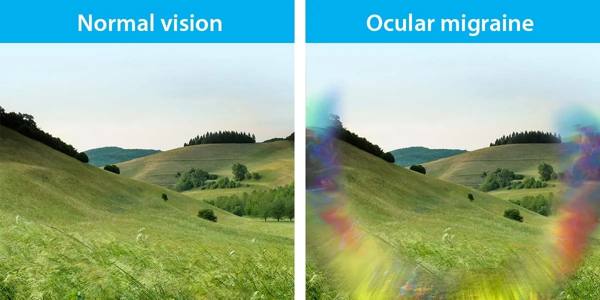 An ocular migraine