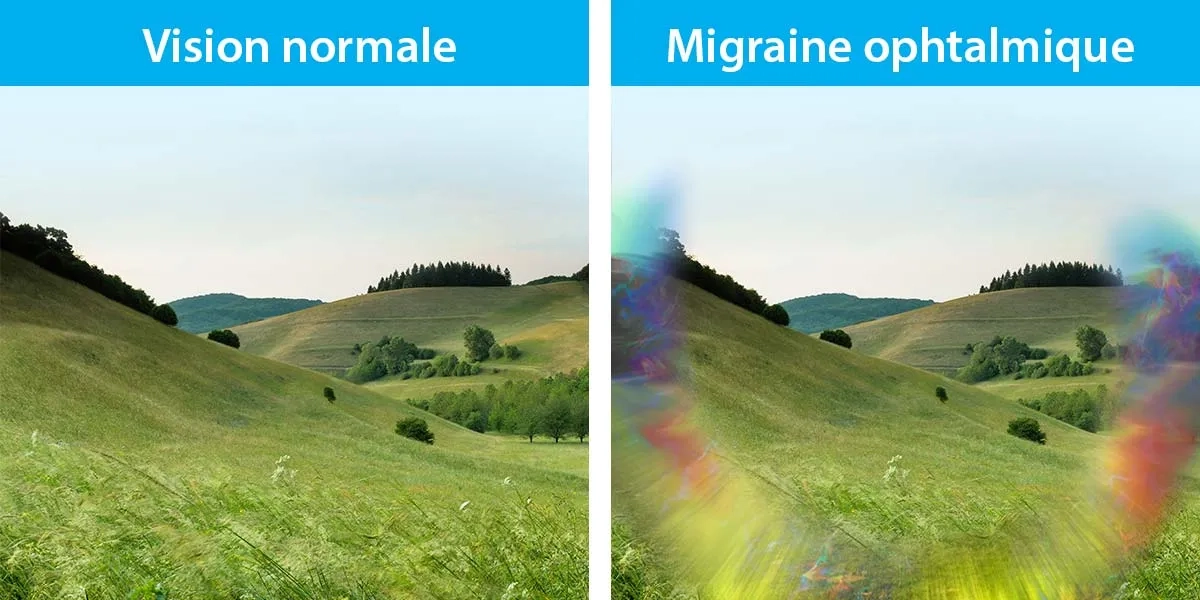 Une migraine ophtalmique