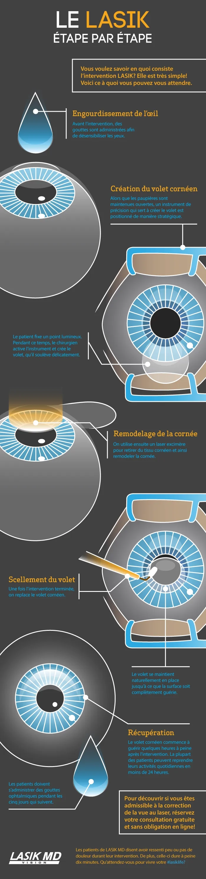 Le LASIK étape par étape