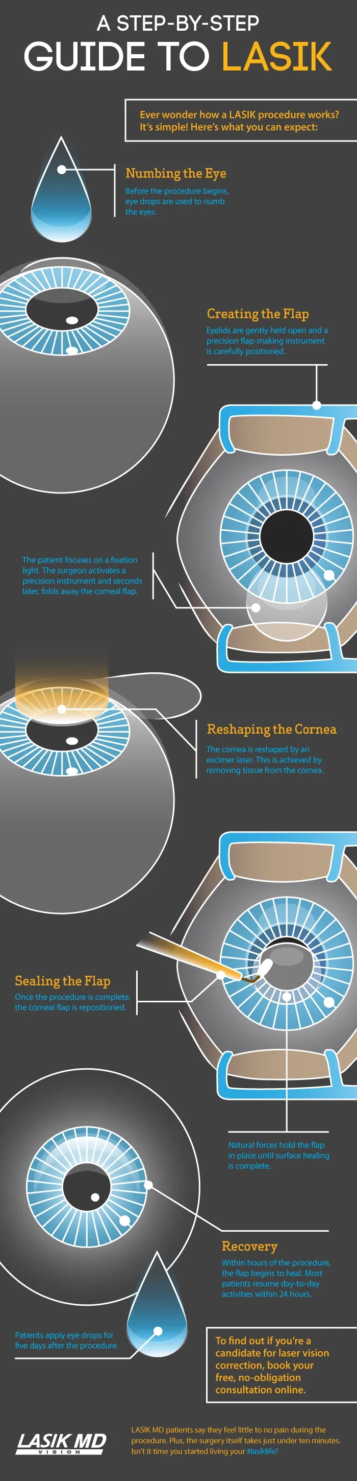 Step-by-step guide to LASIK